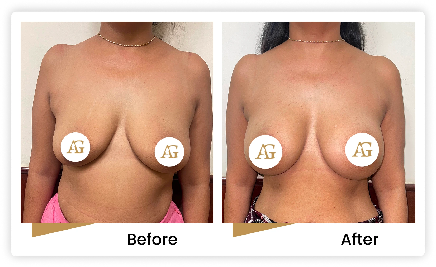 Breast Implant Augmentation