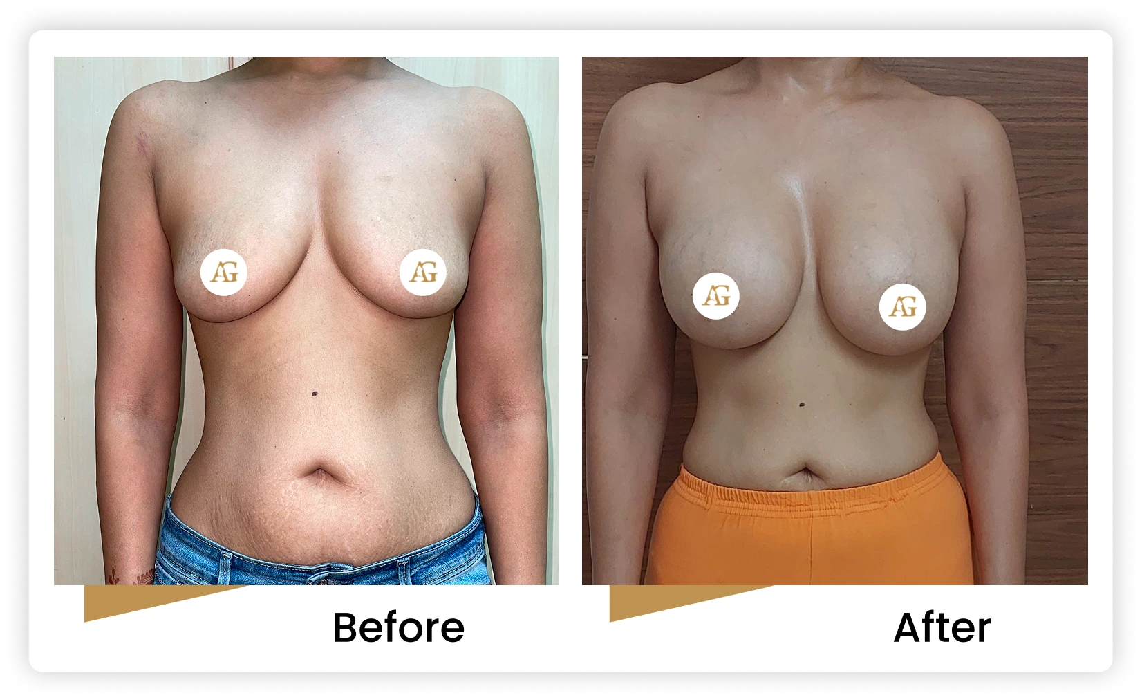 Breast Implant Surgery in Mumbai