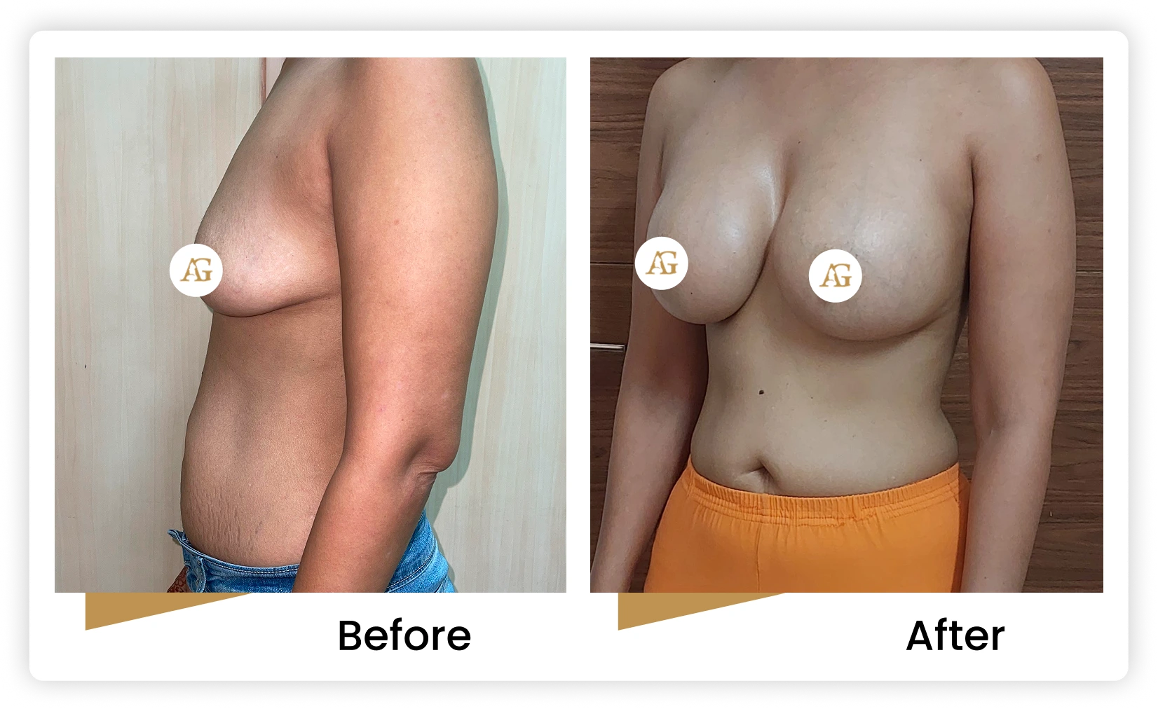 Breast Implant Surgery