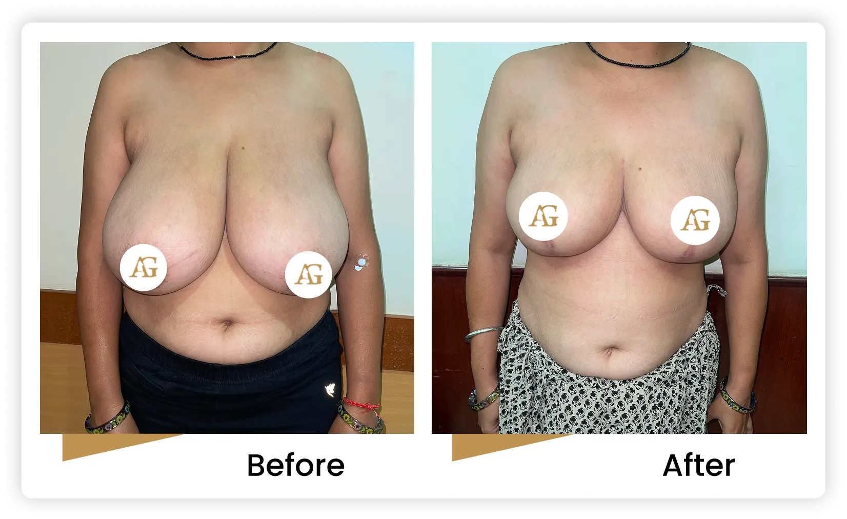 Breast Reduction Surgery in Mumbai