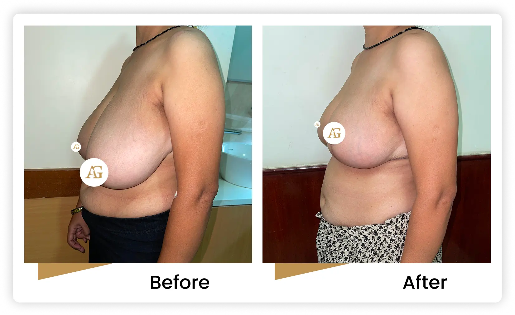 Breast Reduction in Mumbai before & after