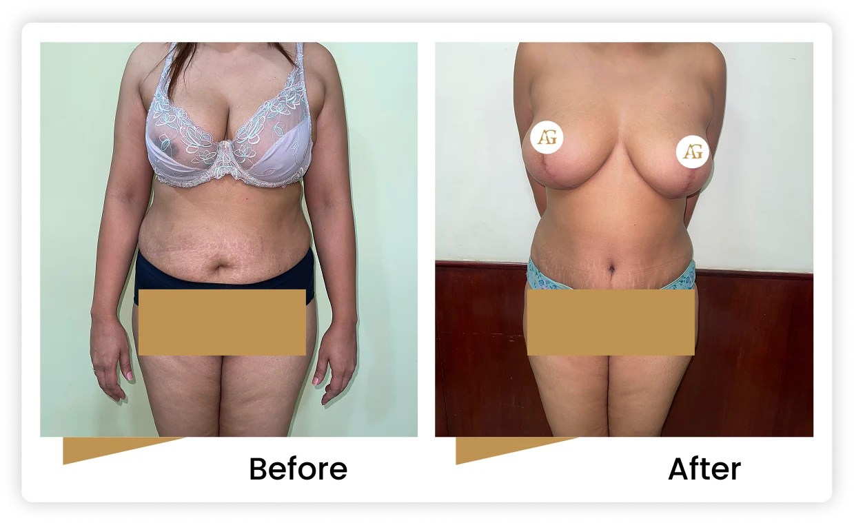 Breast Lift & Tummy Tuck surgery in Mumbai