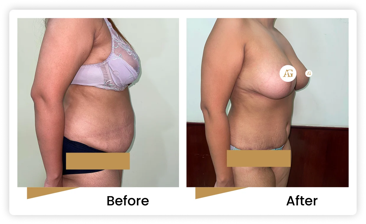 Breast Lift & Tummy Tuck surgery