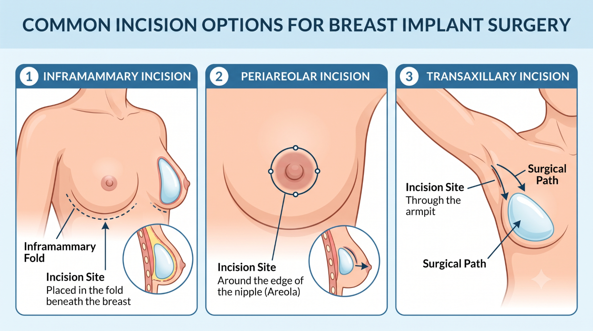 breast implant surgery incision