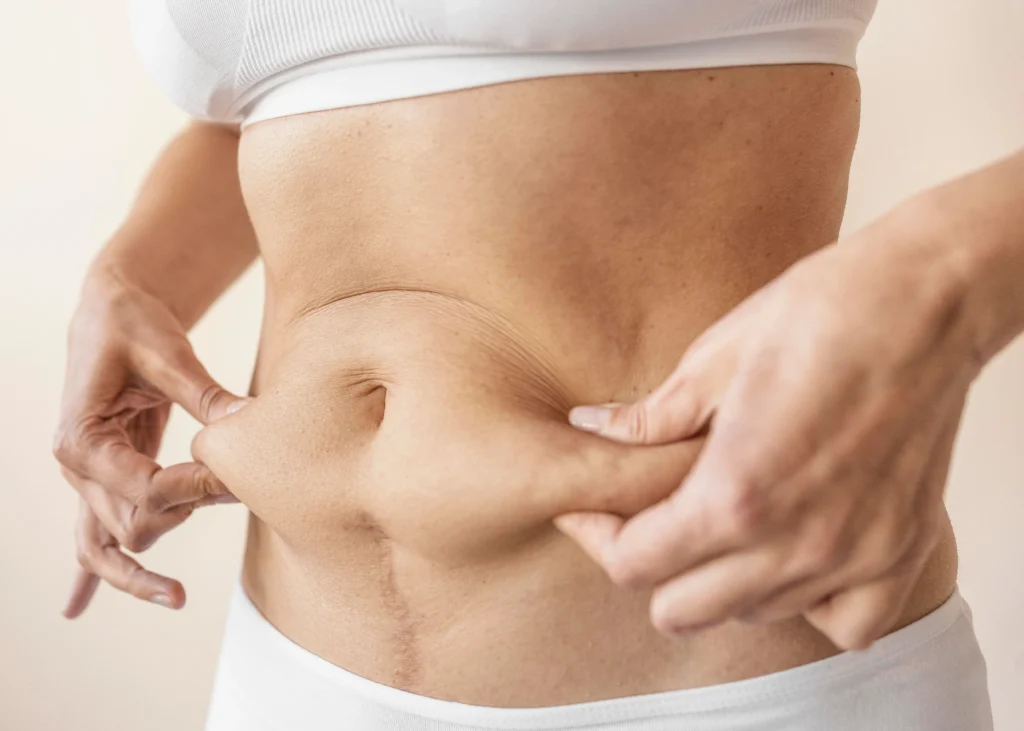 Tummy Tuck After C Section Tummy Tuck After C Section