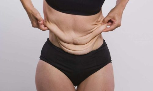 Tighten skin with body contouring surgery