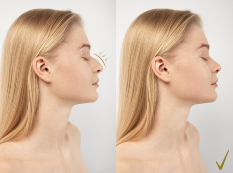 Rhinoplasty