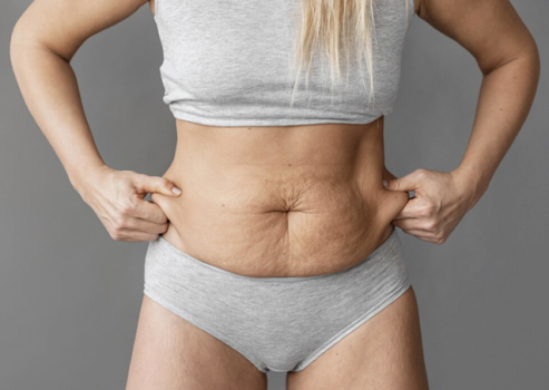 Tummy Tuck