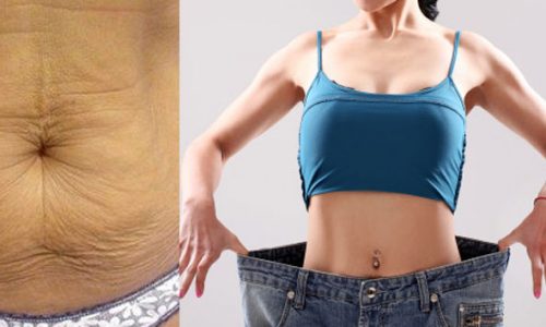 Tighten-Your-Skin-after-Weight-Loss