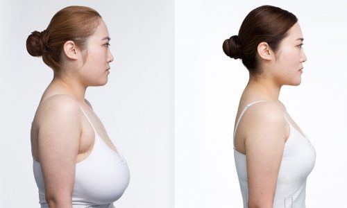 What results can be expected after breast reduction surgery